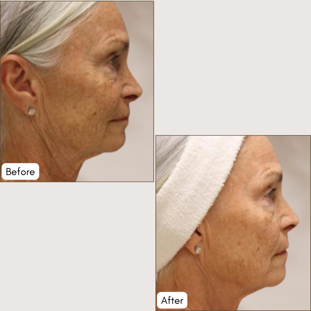 Radio Frequency Microneedling (PiXeL8-RF) Treatment
