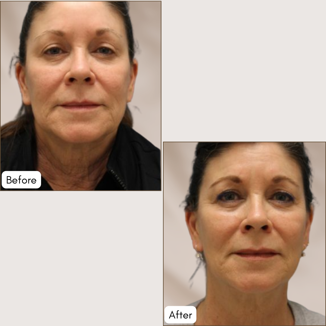 Radio Frequency Microneedling (PiXeL8-RF) Treatment