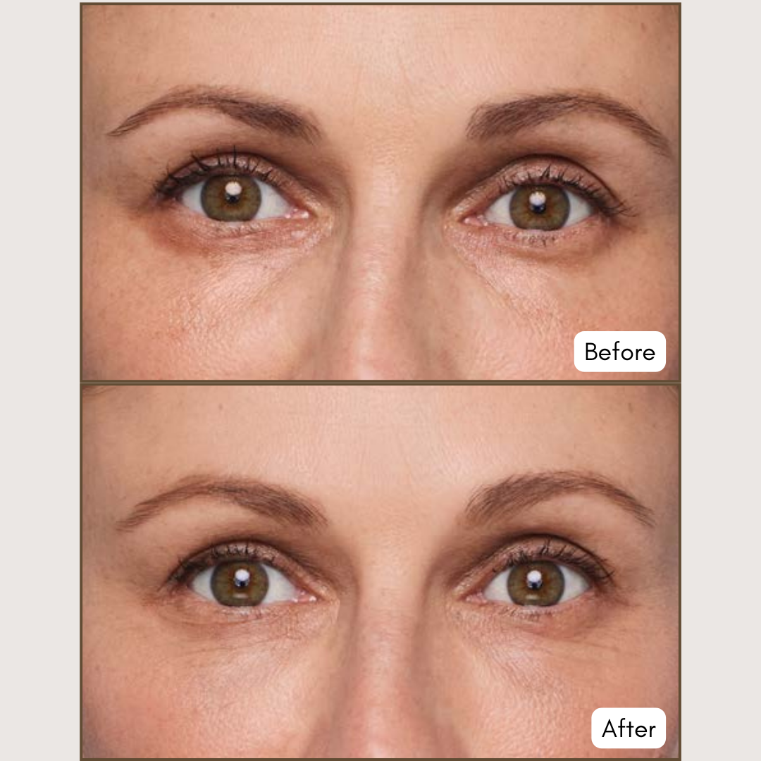 JUVÉDERM® VOLBELLA® XC
