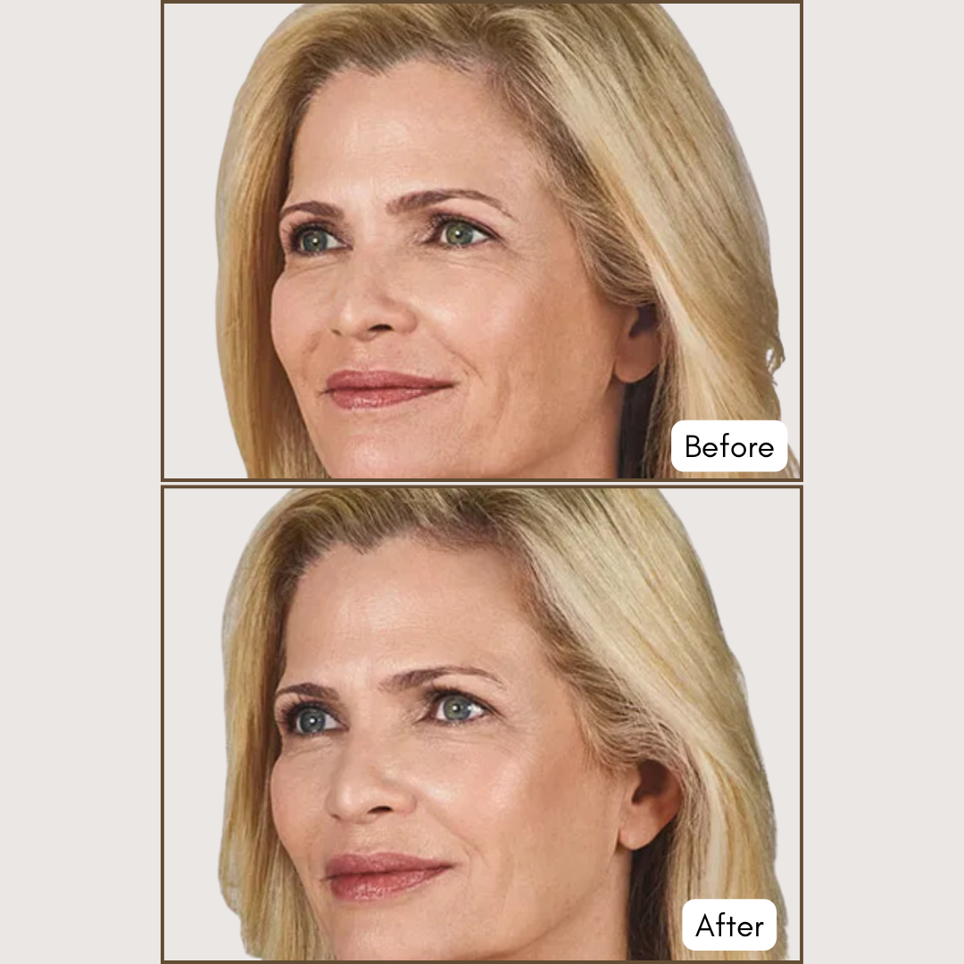 JUVÉDERM® VOLBELLA® XC