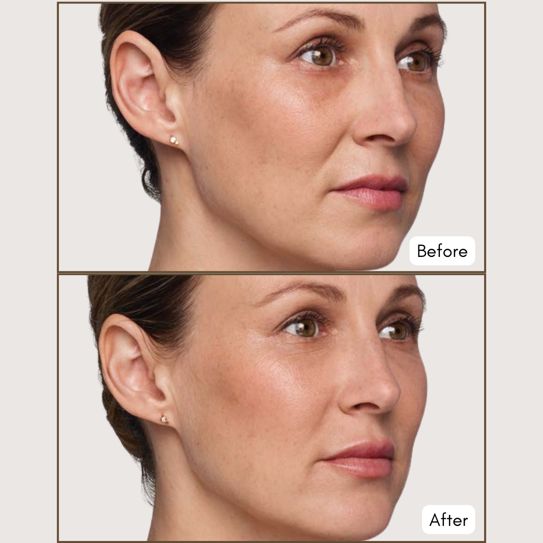 JUVÉDERM® VOLUMA® XC