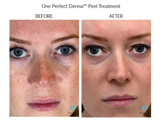 The Perfect Derma Chemical Peel (Heavy Chemical Peel)