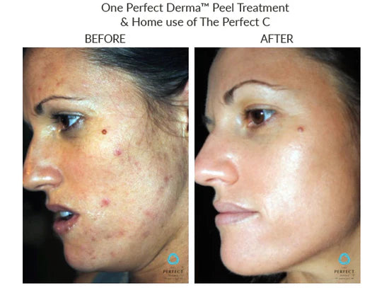 The Perfect Derma Chemical Peel (Heavy Chemical Peel)