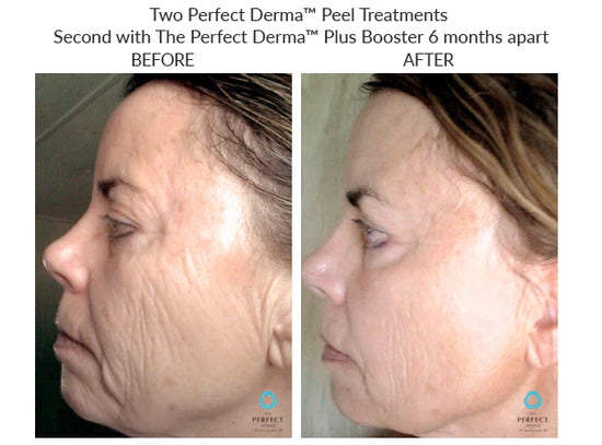 The Perfect Derma Chemical Peel (Heavy Chemical Peel)