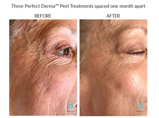 The Perfect Derma Chemical Peel (Heavy Chemical Peel)