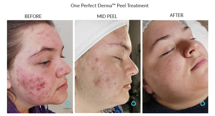 The Perfect Derma Chemical Peel (Heavy Chemical Peel)