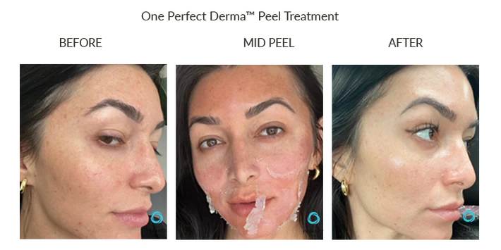 The Perfect Derma Chemical Peel