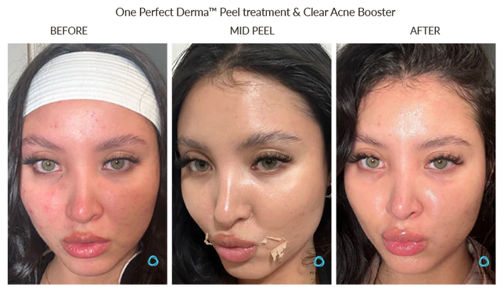 The Perfect Derma Chemical Peel