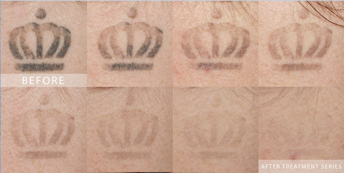 Tattoo Removal