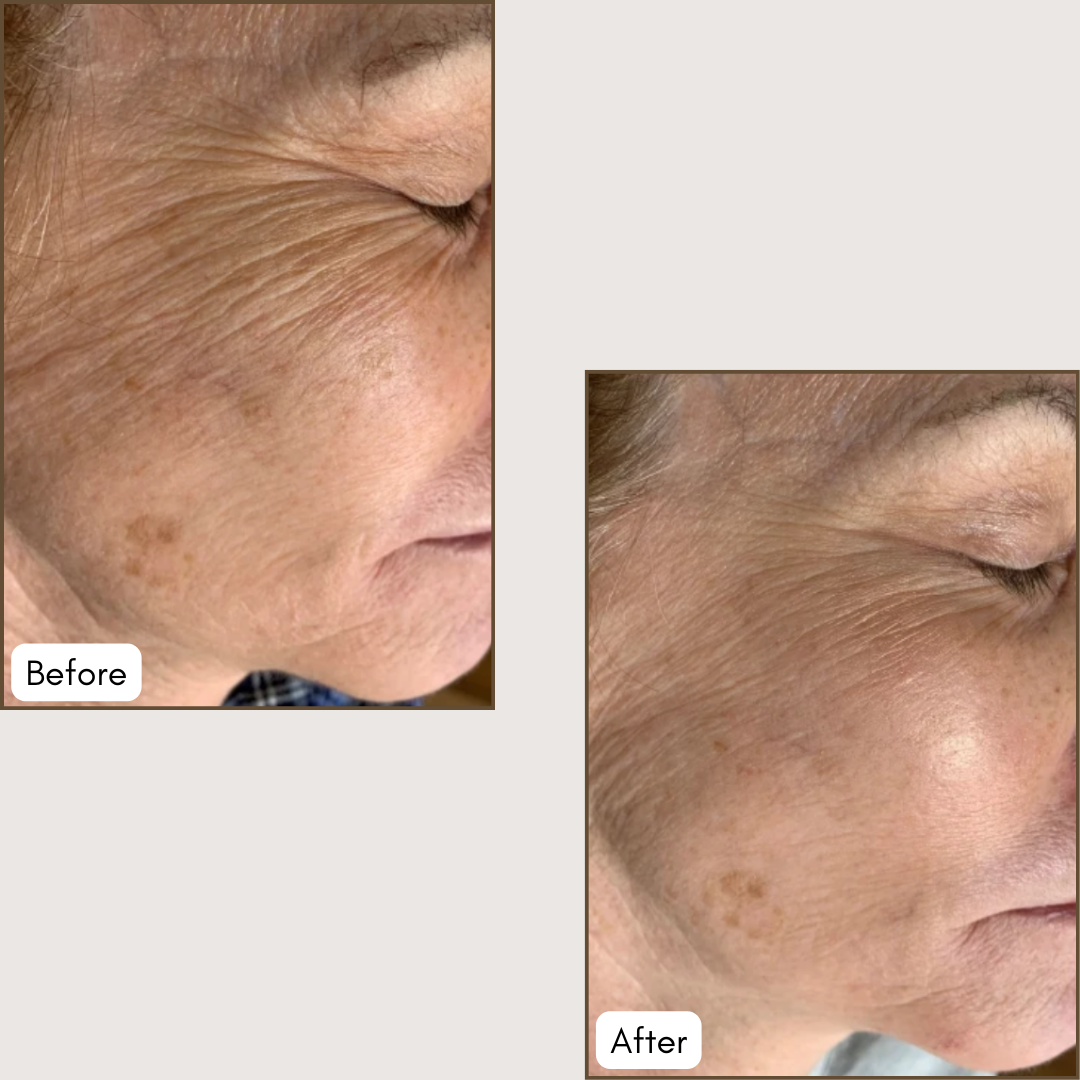 Microneedling