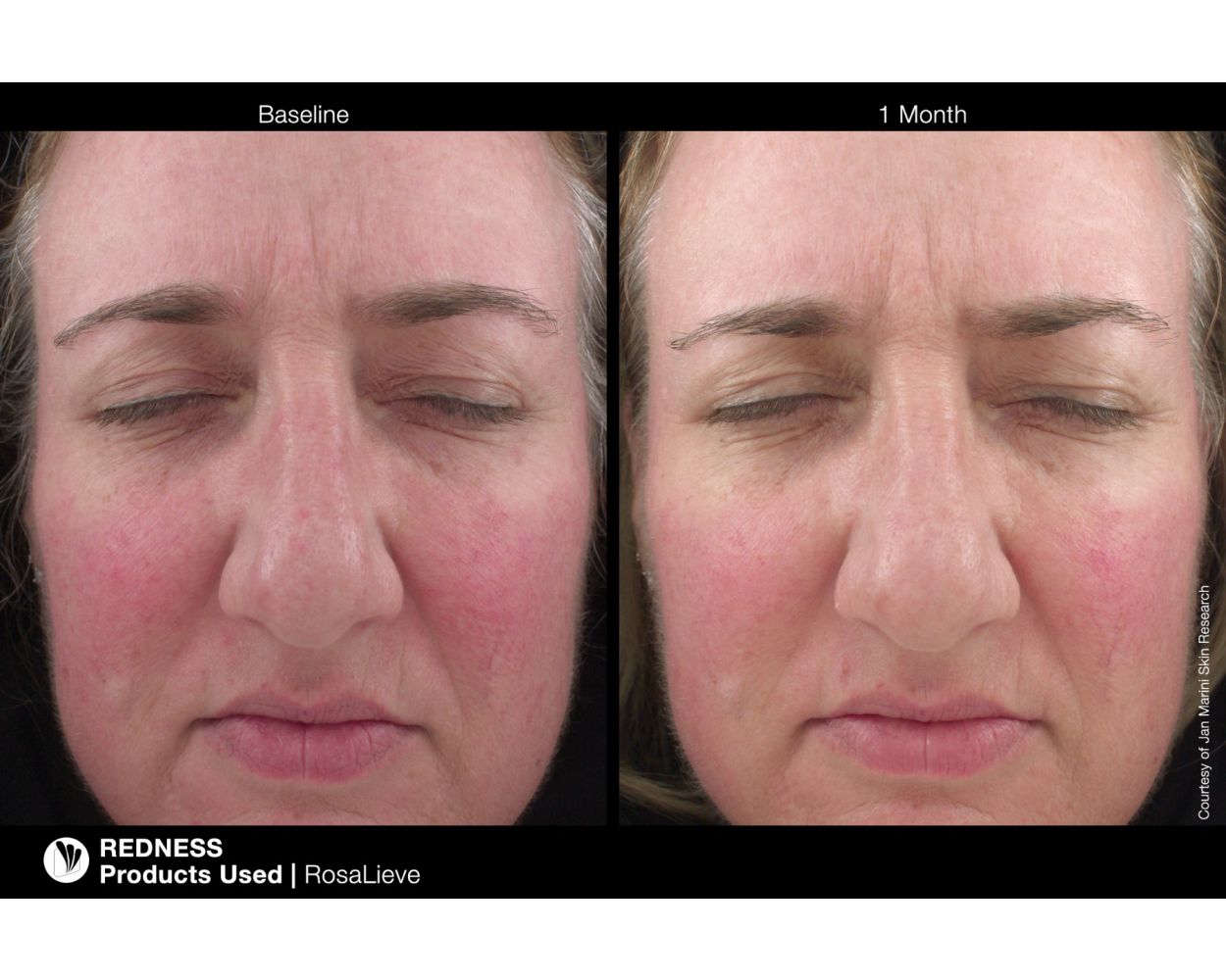 RosaLieve® Redness Reducing Complex