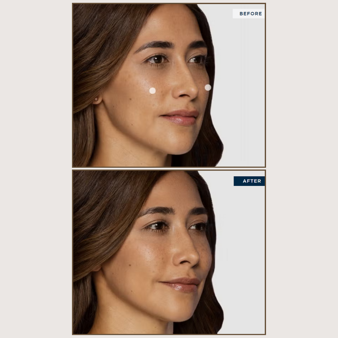 Restylane® Contour