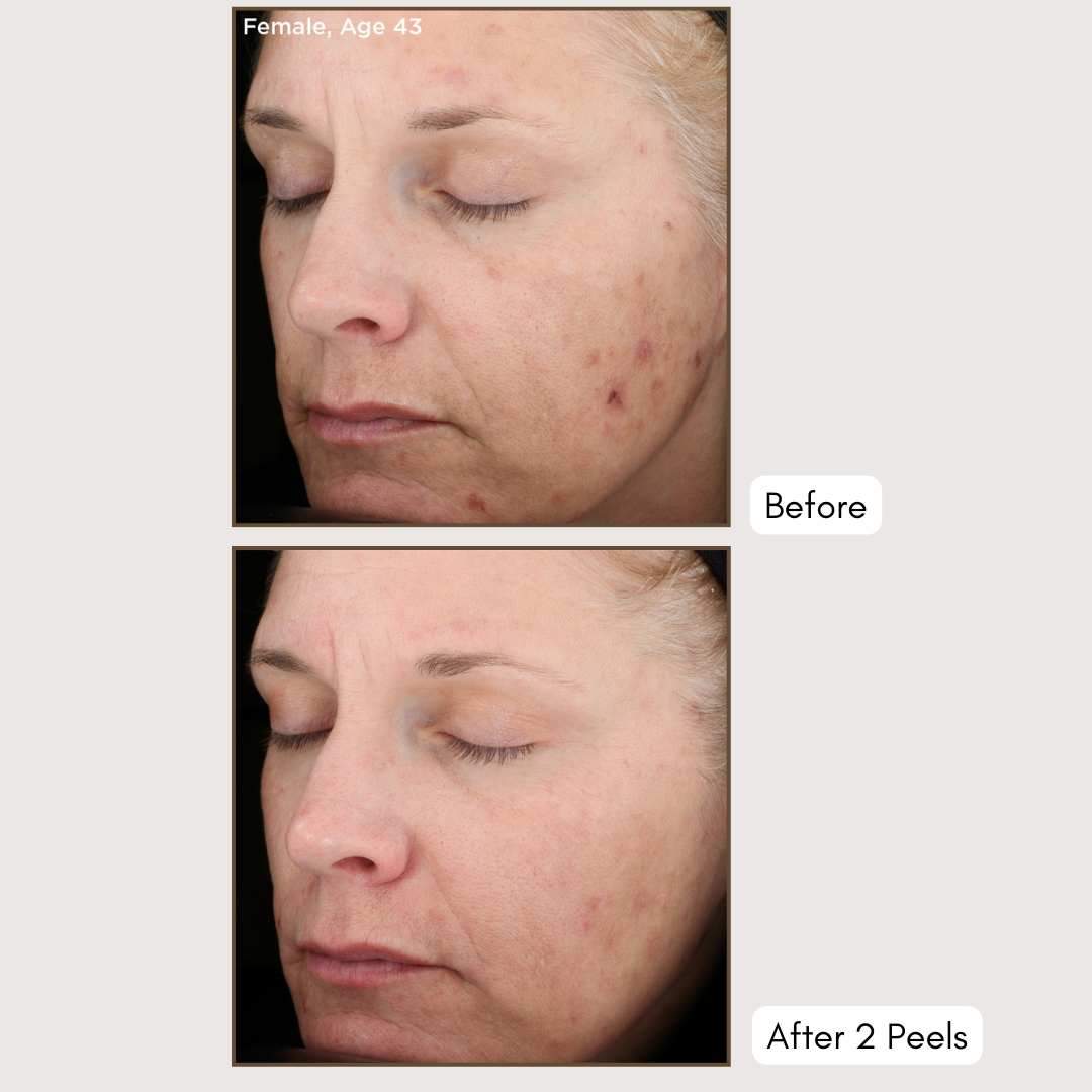 Vitalize Peel® (Medium Chemical Peel)