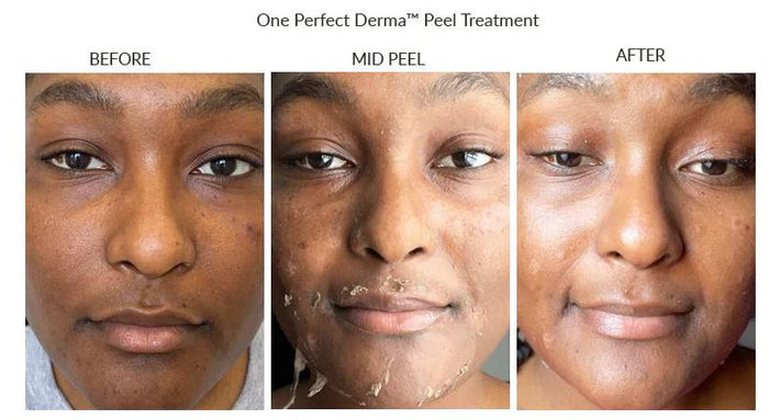 The Perfect Derma Chemical Peel